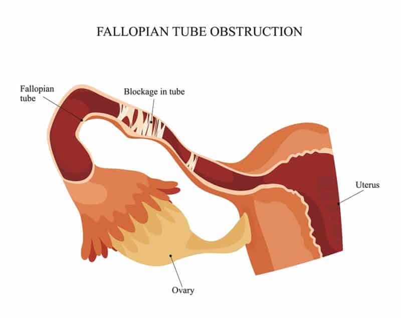Tubal Blockage Causes, Symptoms, Treatments & Our Approach