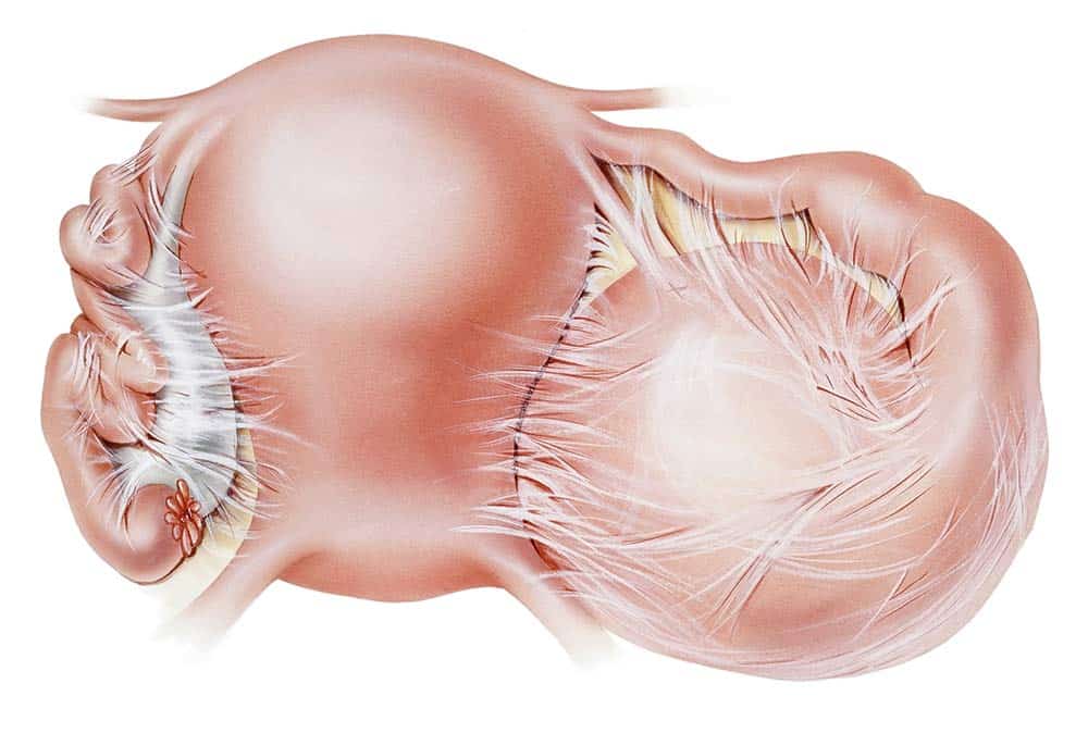 Hydrosalpinx (Blocked Fallopian Tube)