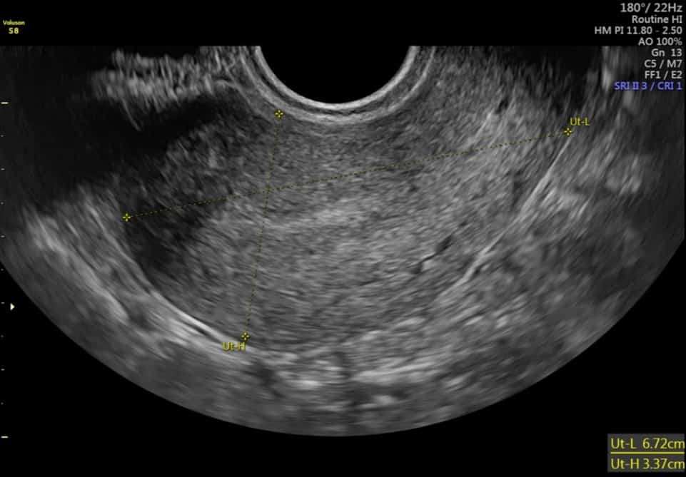 Ultrasound of uterus: Diagnosing excessive period bleeding and bad period cramps