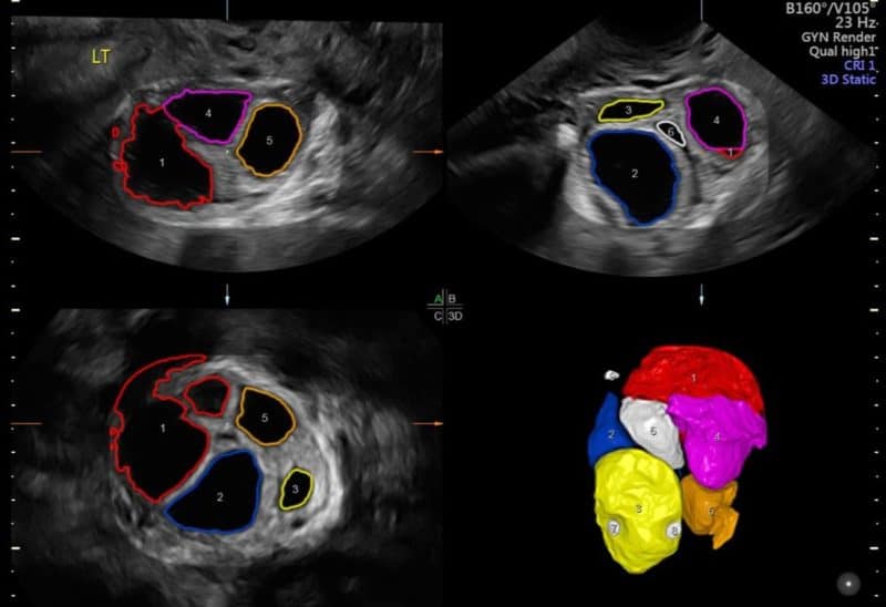 Advanced Pelvic Ultrasound - In-house At Veritas Fertility & Surgery