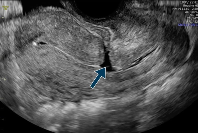 Uterine Isthmocele Causes, Symptoms and our Approach to Treatments