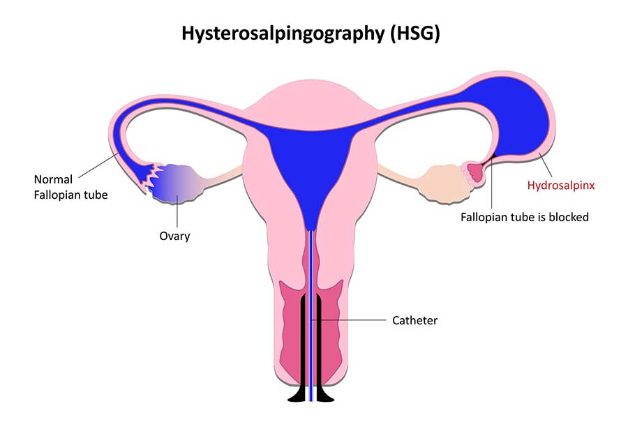 Hysterosalpingogram