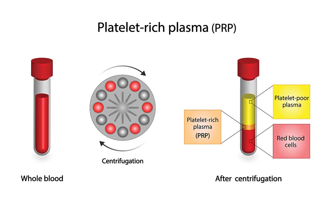 What is PRP?