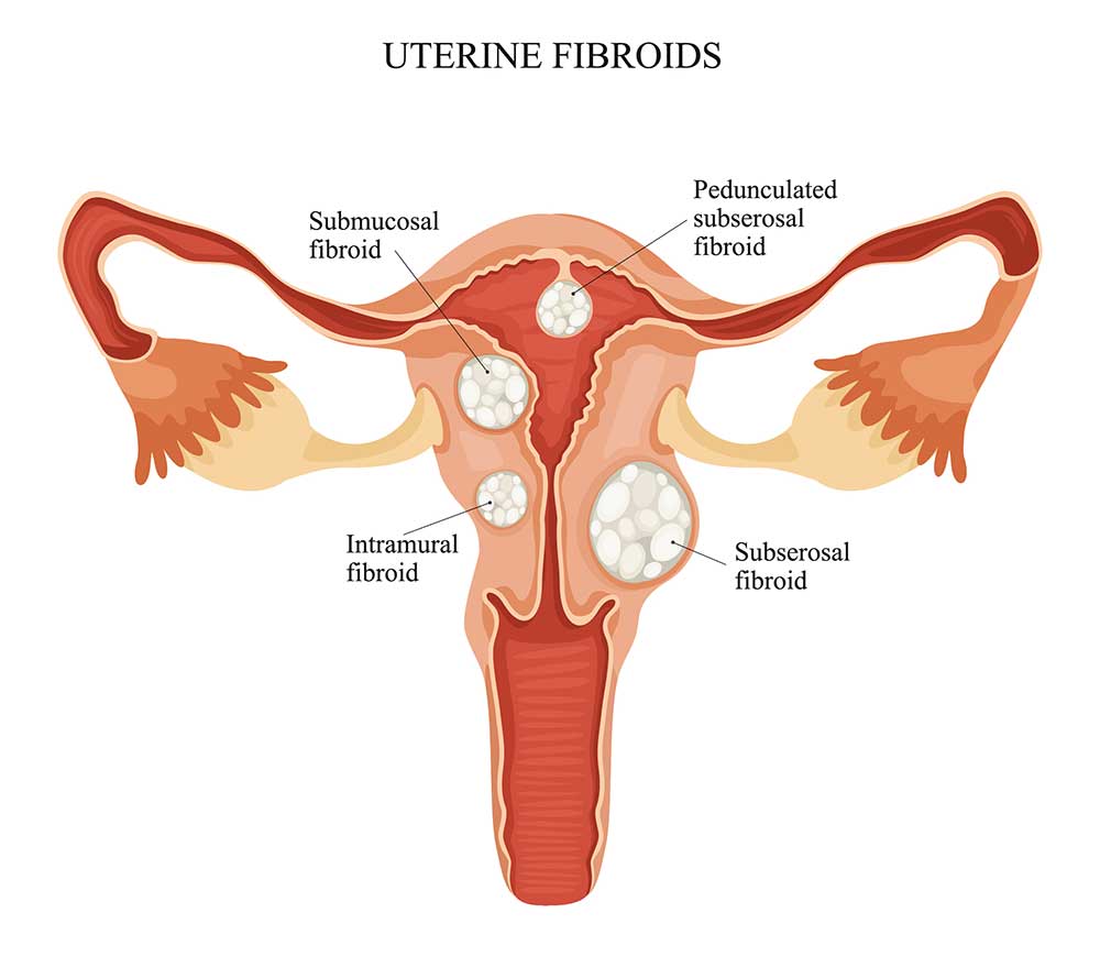 diagram of uterine fibroids