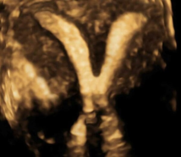 Saline Infusion Sonohysterogram SIS Veritas Fertility saline-infusion-sonohysterogram-sis-veritas-fertility